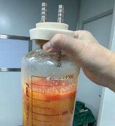 大悟水动力吸脂手术要做多久？